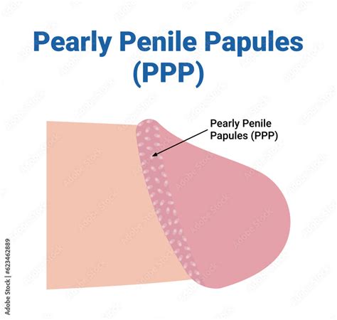 papule penienne|PPP: Pearly Penile Papules Facts and Treatment